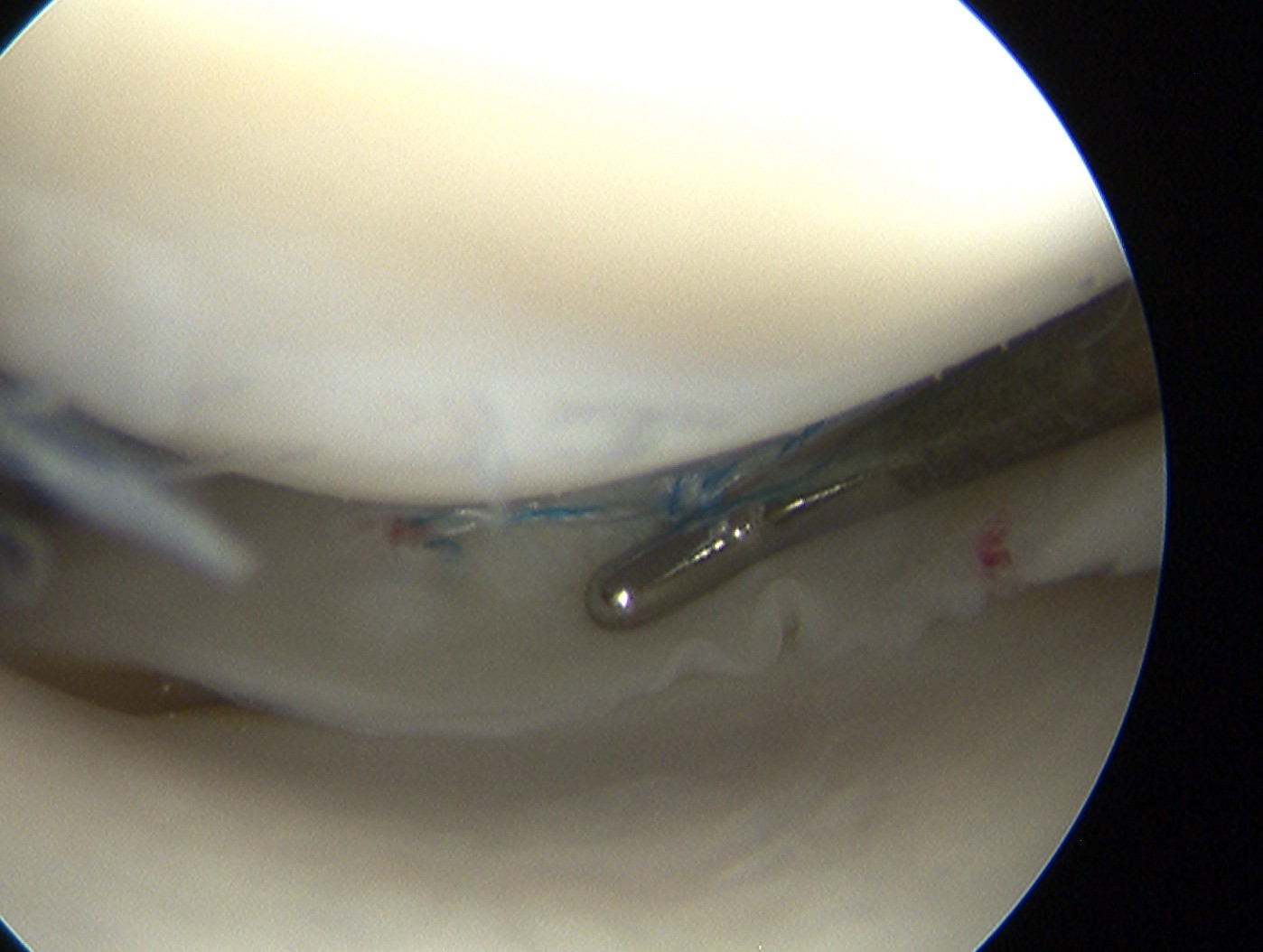 Meniscal Repair Posterior Fastfix